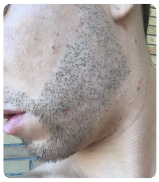 Beard hair transplant risks and recovery