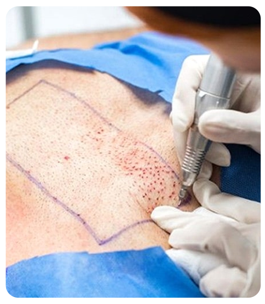 Benefits of body hair transplant