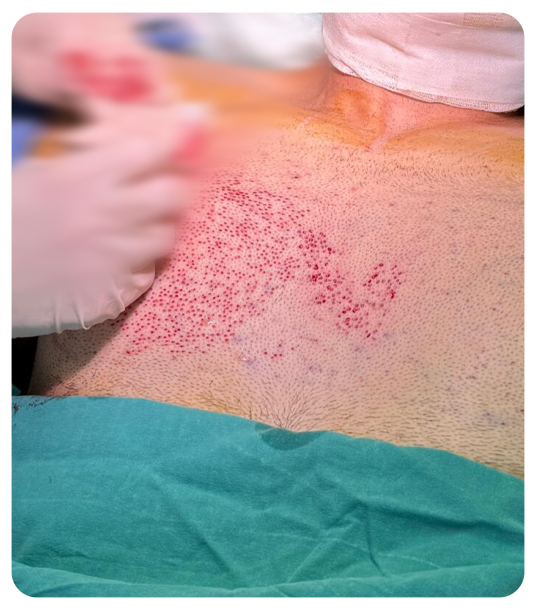 Who should consider body hair transplant