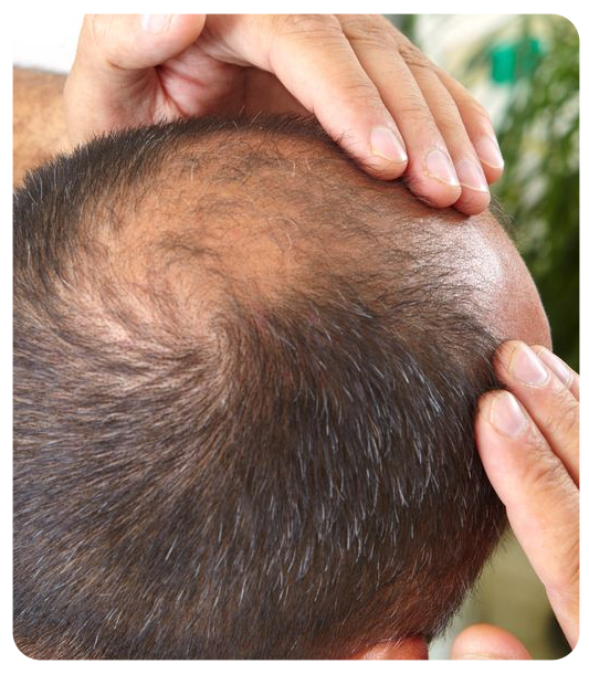 Possible risks and complications of body hair transplant