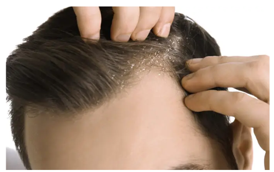 Dandruff and scalp irritation contributing to temporary hair fall