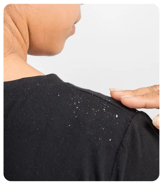 Common symptoms of dandruff including visible flakes and itchy scalp