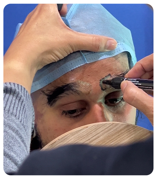 Who should consider an eyebrow hair transplant