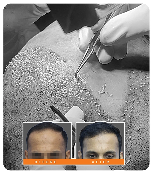 Celebrity hair transplant result at IHT Clinics