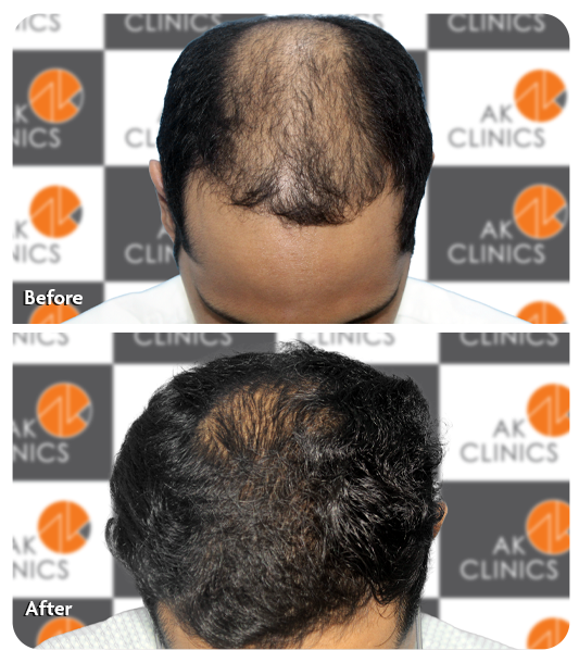 Benefits of GFC therapy for hair loss treatment