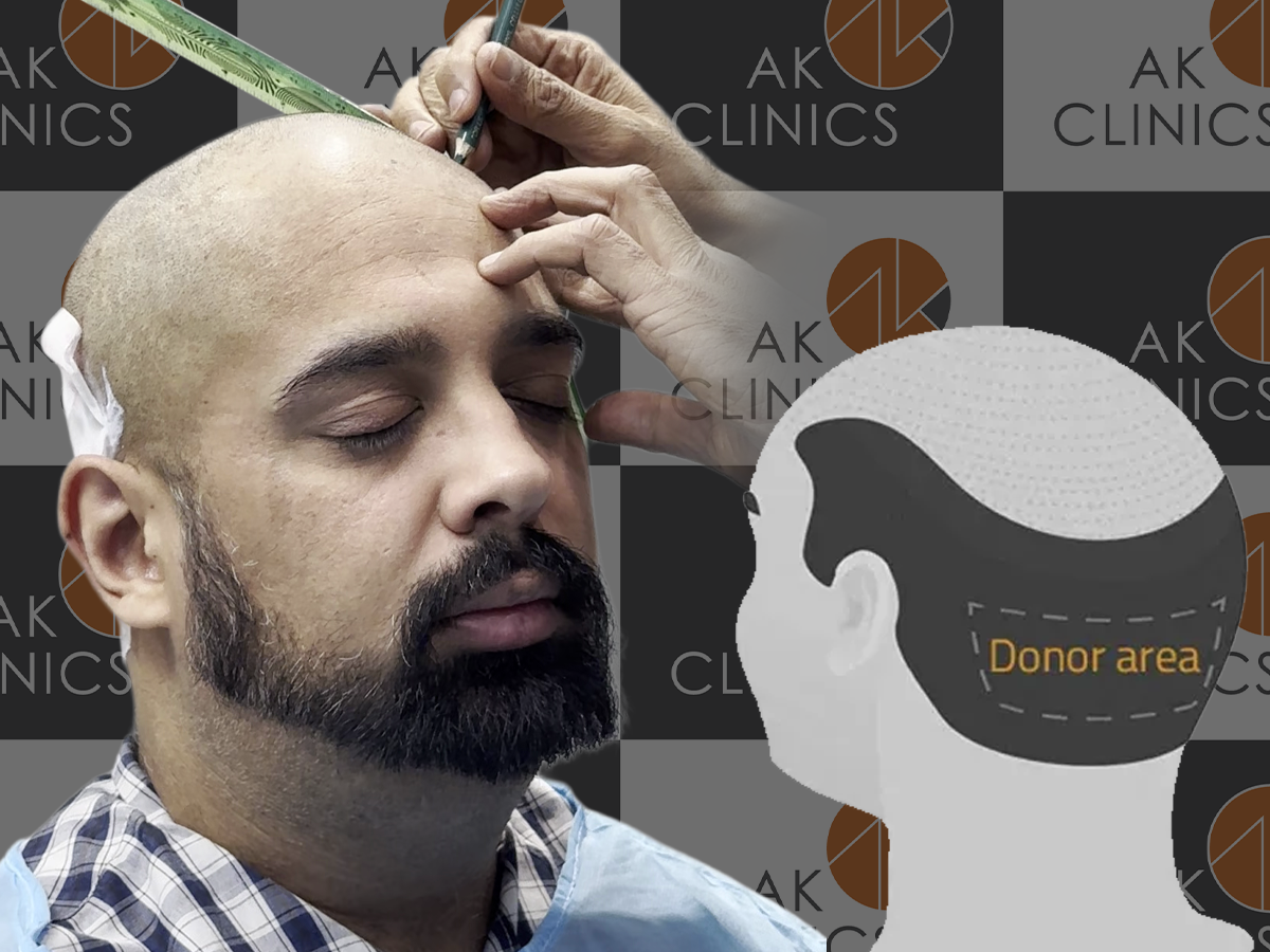 Hairline Design & Donor Area Planning in Men