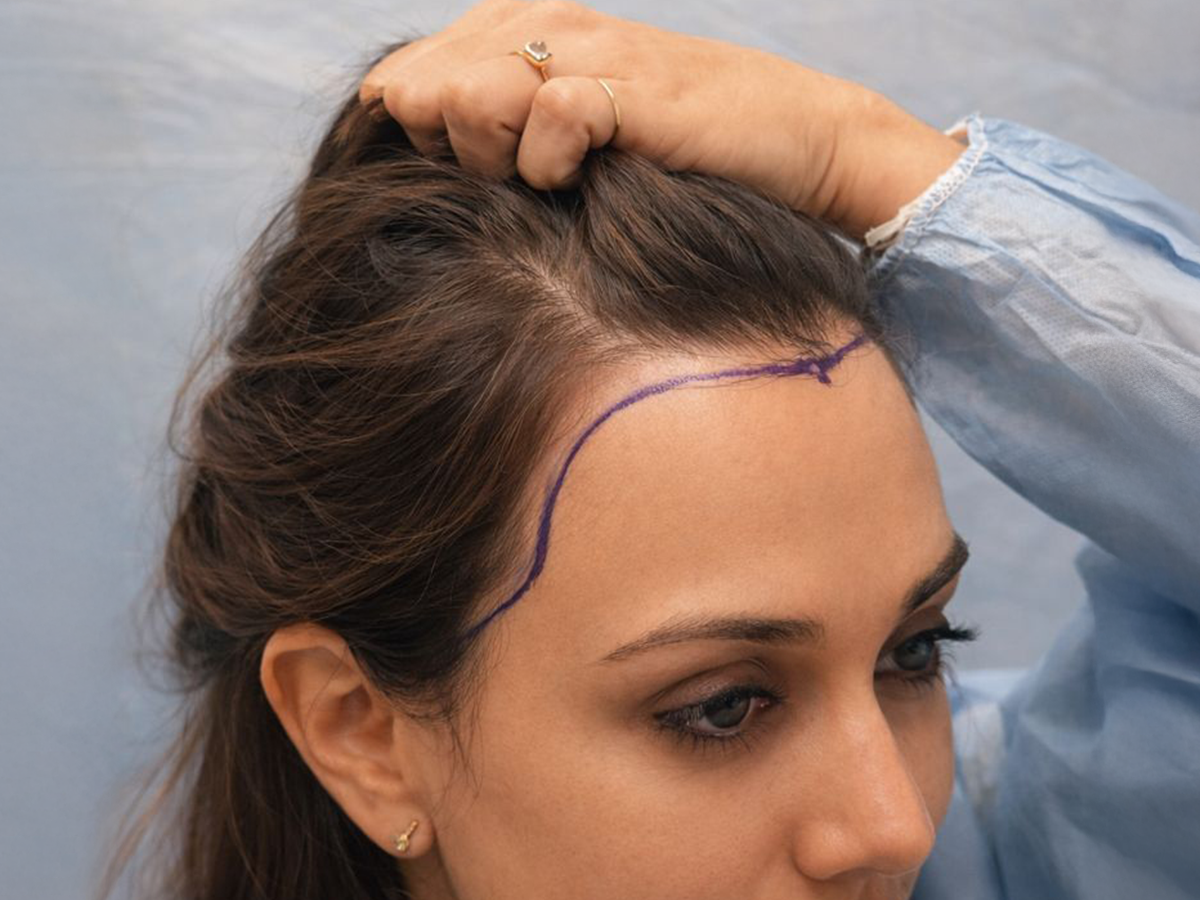 Celebrity hair transplant result at AK Clinics