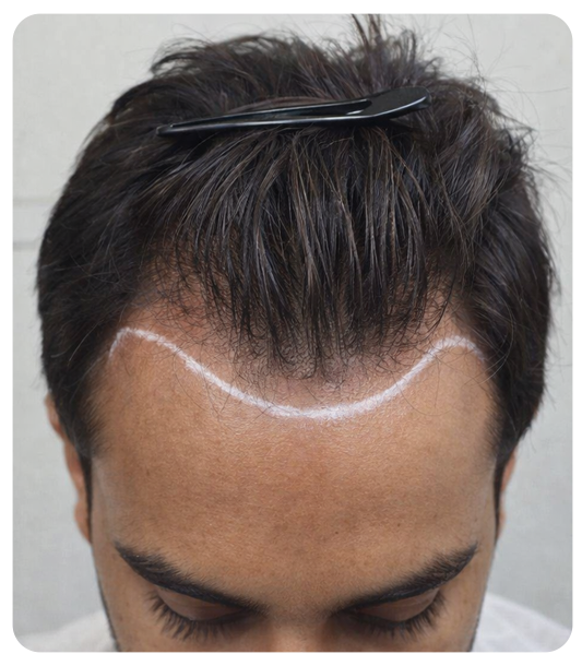 Ideal candidate for unshaven FUE hair transplant