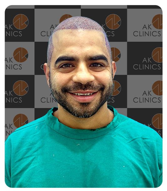 Ideal Candidate for hair transplant