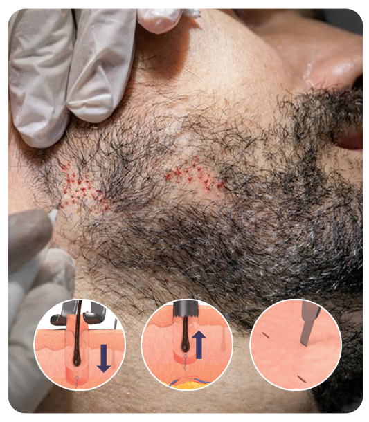 Beard hair transplant results