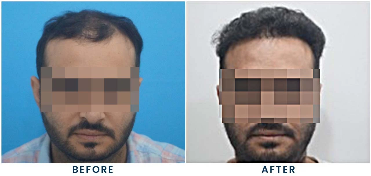 Patient result 4 – front view