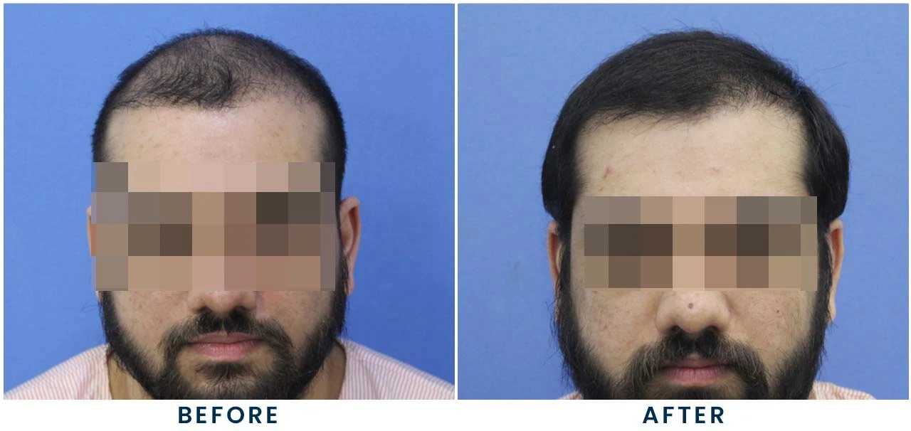 Patient result 5 – front view