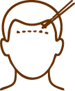 Male Hair Transplant