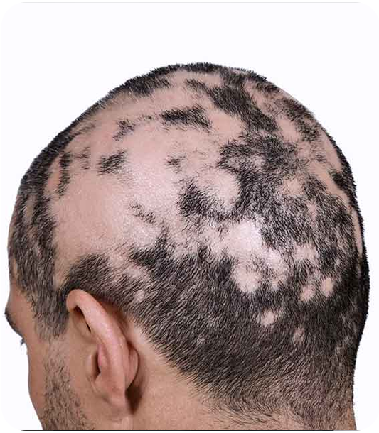 Hair loss associated with underlying medical conditions