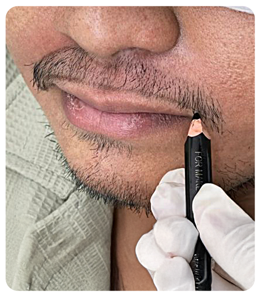 Who should consider a moustache hair transplant