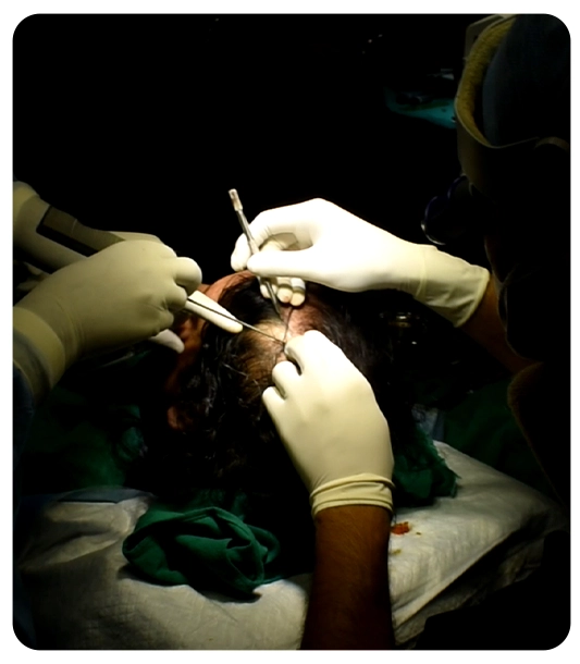 How to choose the right hair transplant clinic in Chandigarh