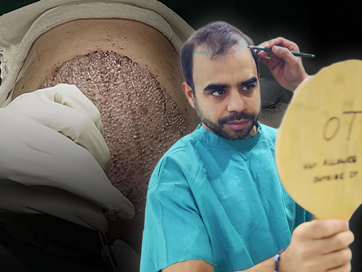 Risks & Limitations in Male Hair transplant