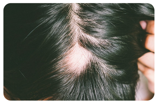 Scalp psoriasis causing inflammation and temporary hair shedding