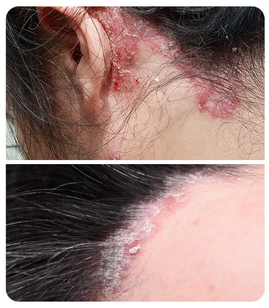 Common symptoms of scalp psoriasis including thick scales and scalp redness