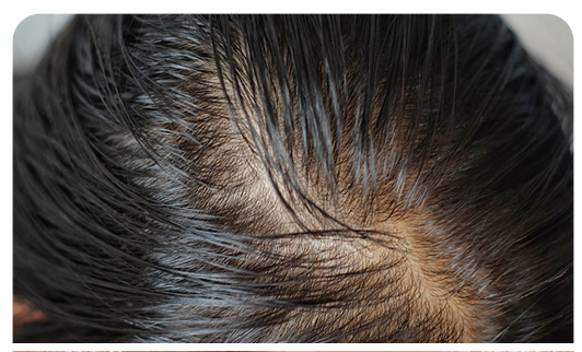 Seborrheic dermatitis causing scalp inflammation and temporary hair shedding