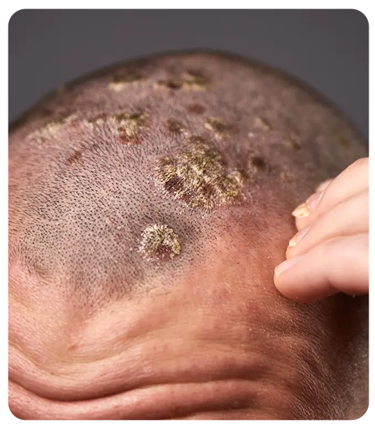 People more likely to develop scalp psoriasis